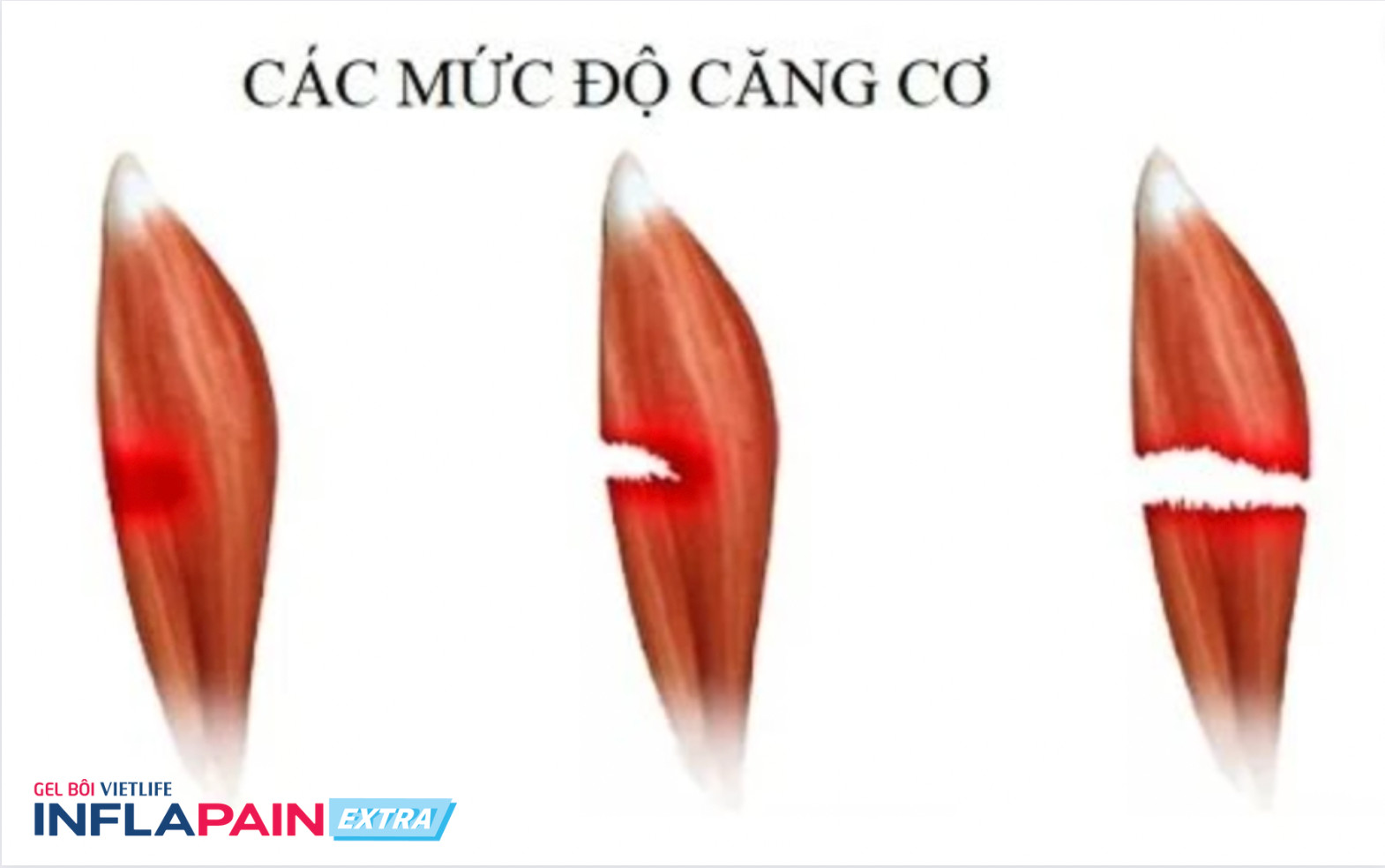 Các mức độ căng cơ